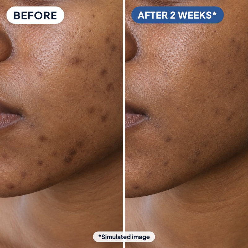 Post-acne dark spots on the cheek and jaw