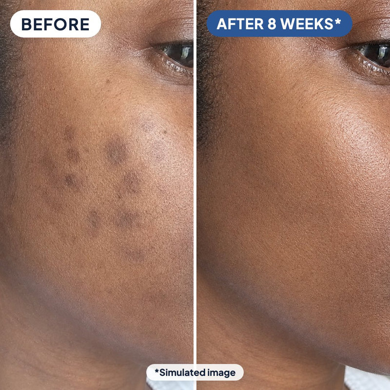 Older dark spots on the cheek