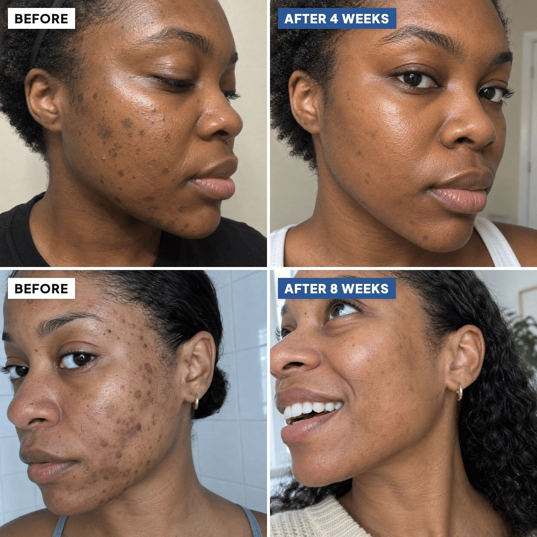 Before and after: dark spots faded after 4 and 8 weeks on two women (simulated image)