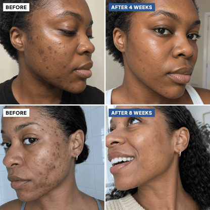 Before and after: dark spots faded after 4 and 8 weeks on two women (simulated image)