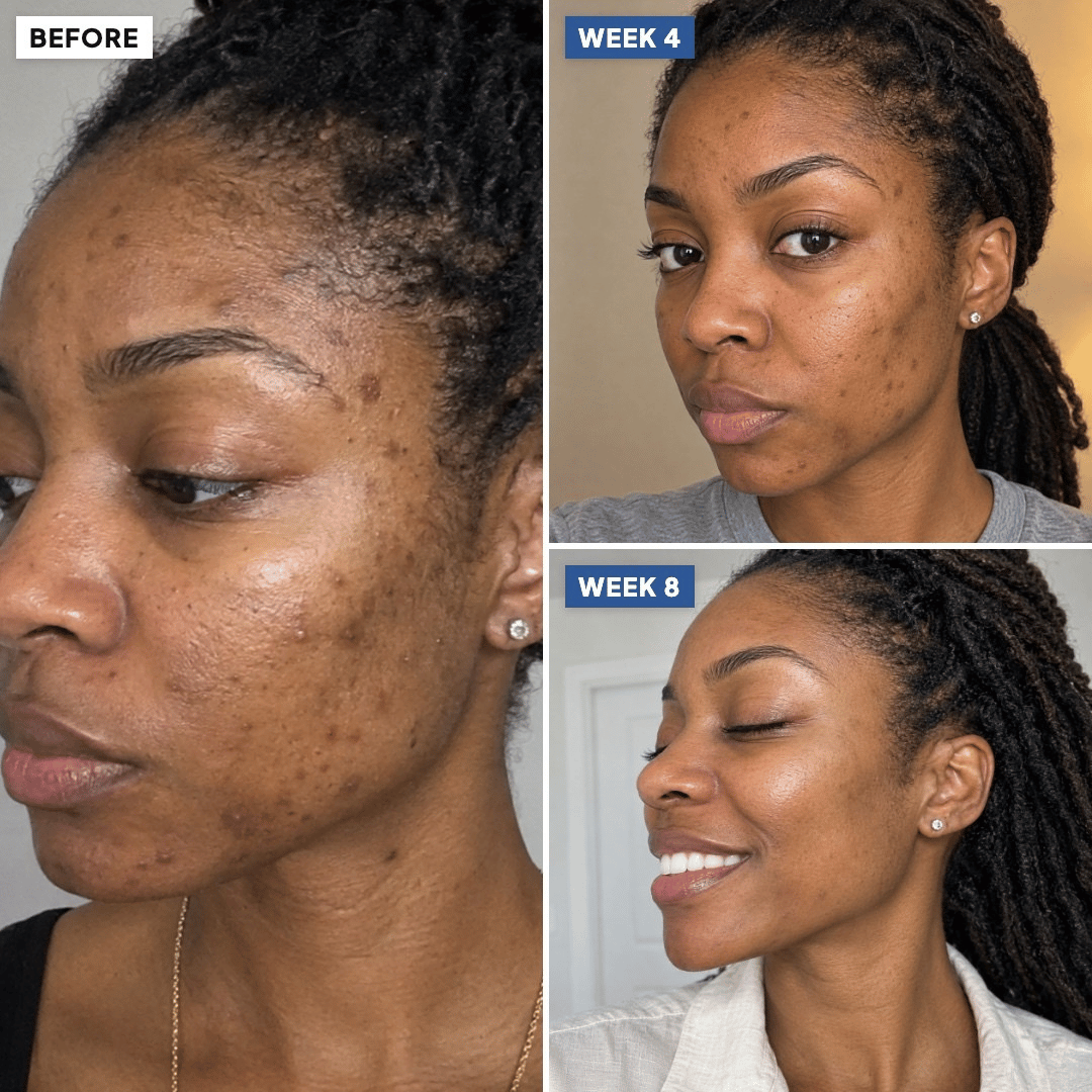 Dark spots timeline: before, week 4 and week 8 (simulated image)