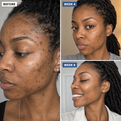 Dark spots timeline: before, week 4 and week 8 (simulated image)