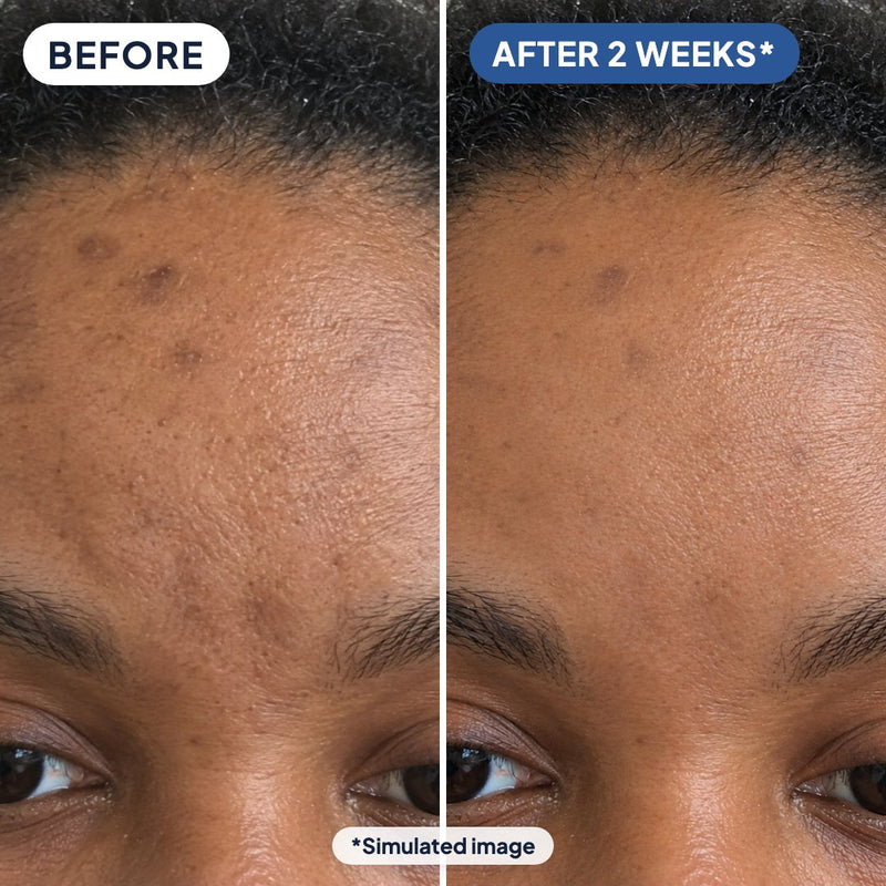Dark spots on the forehead