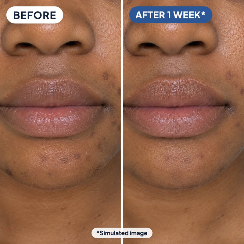 Post-acne dark spots around the mouth and chin