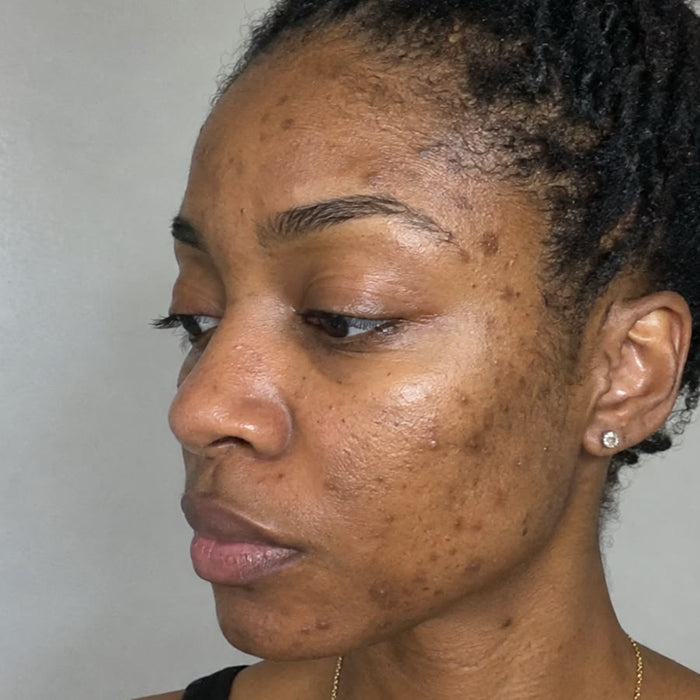Before: post-acne dark spots on the cheek, temple and jaw (simulated image)
